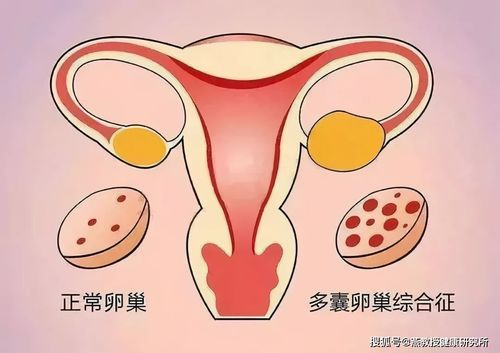 多囊卵巢喝低脂牛奶吗,多囊卵巢综合征的患者应该注意哪些饮食？