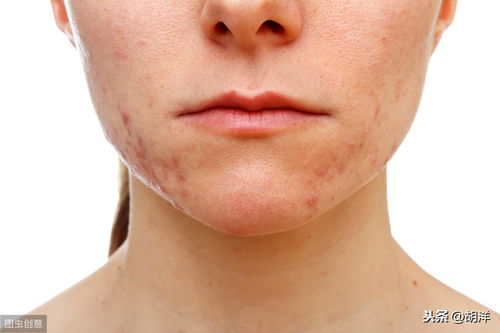脸上出汗多容易老吗,出汗对脸部皮肤有影响吗？